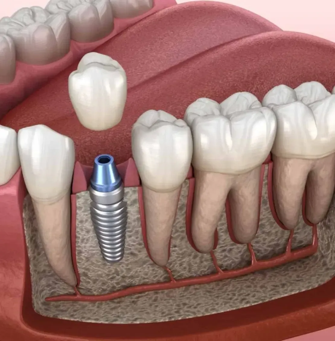 Dental bone grafting illustration showing implant integration and jawbone restoration.