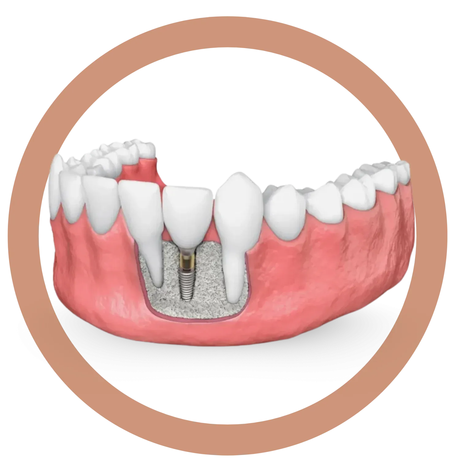 Dental bone grafting illustration