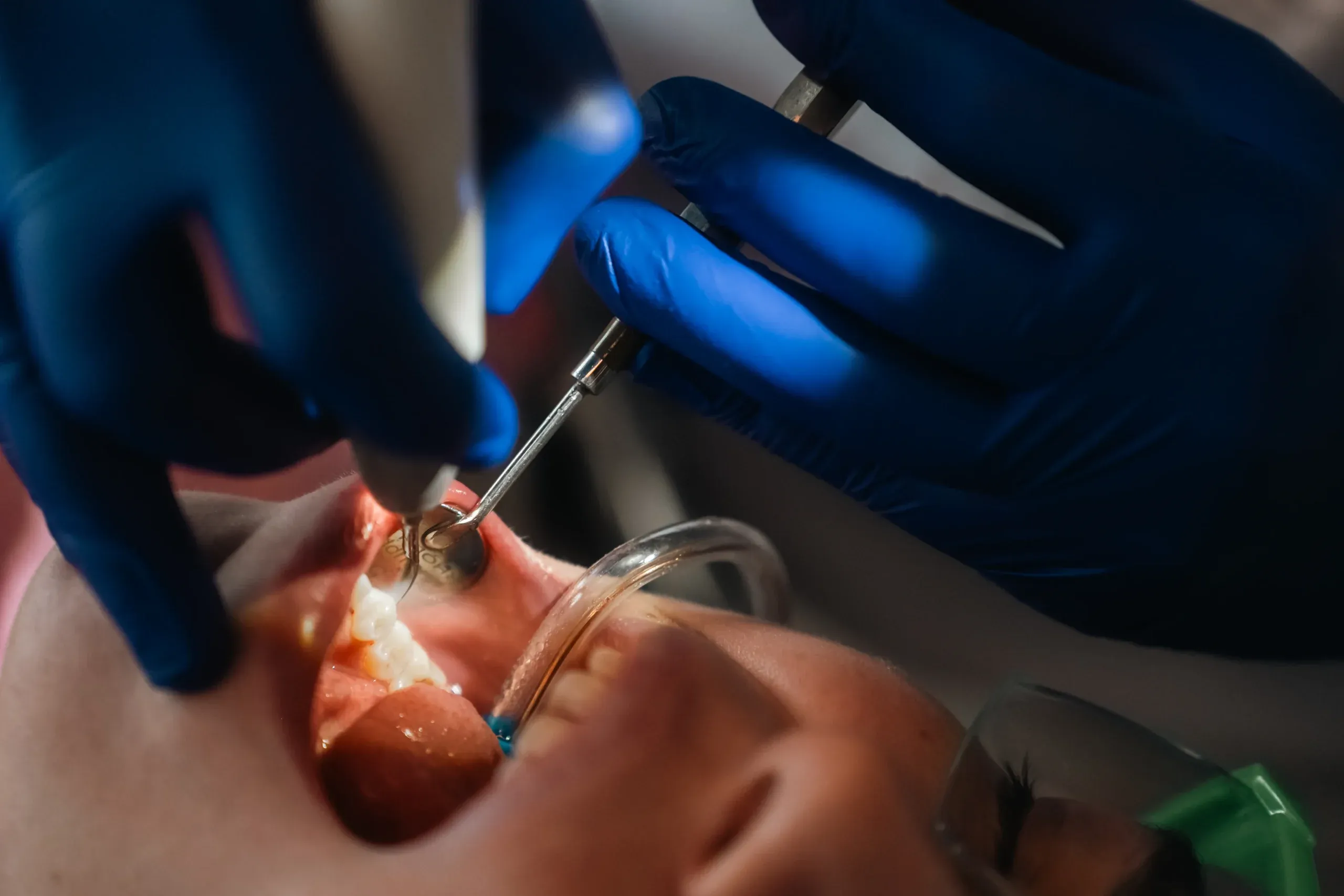 Close-up of a restorative dental procedure at Skyview Dental