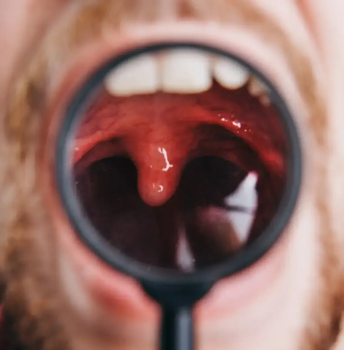 Oral cancer
