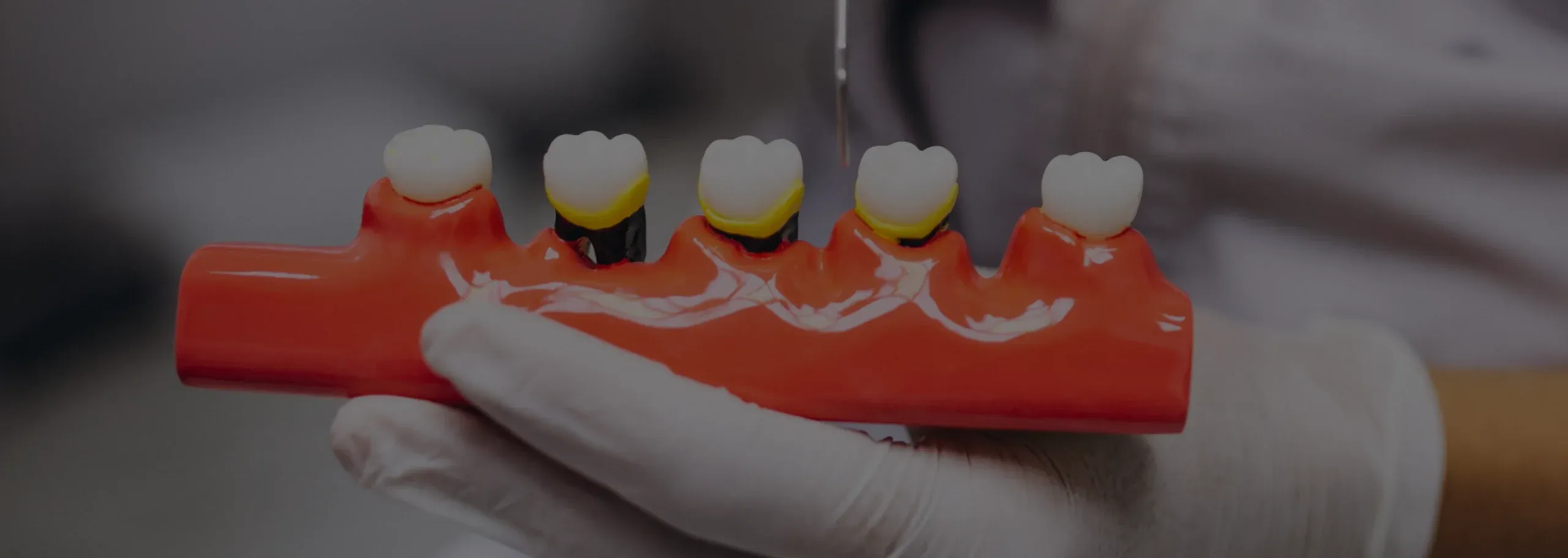 What Are the Benefits of Crowns and Bridges in Noblesville Indiana