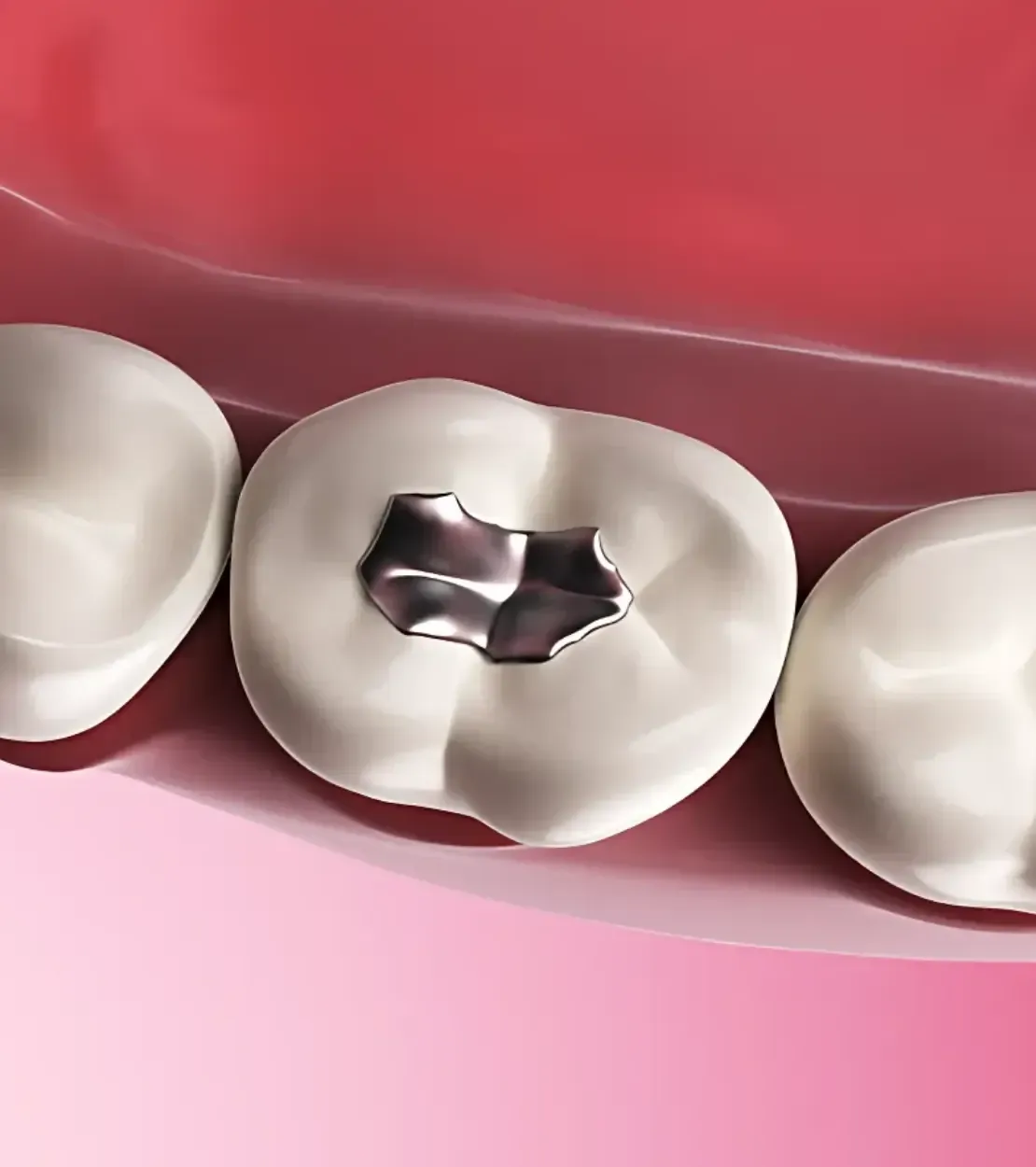 Dental sealants