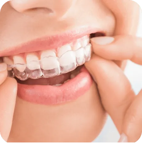 A patient placing a clear aligner