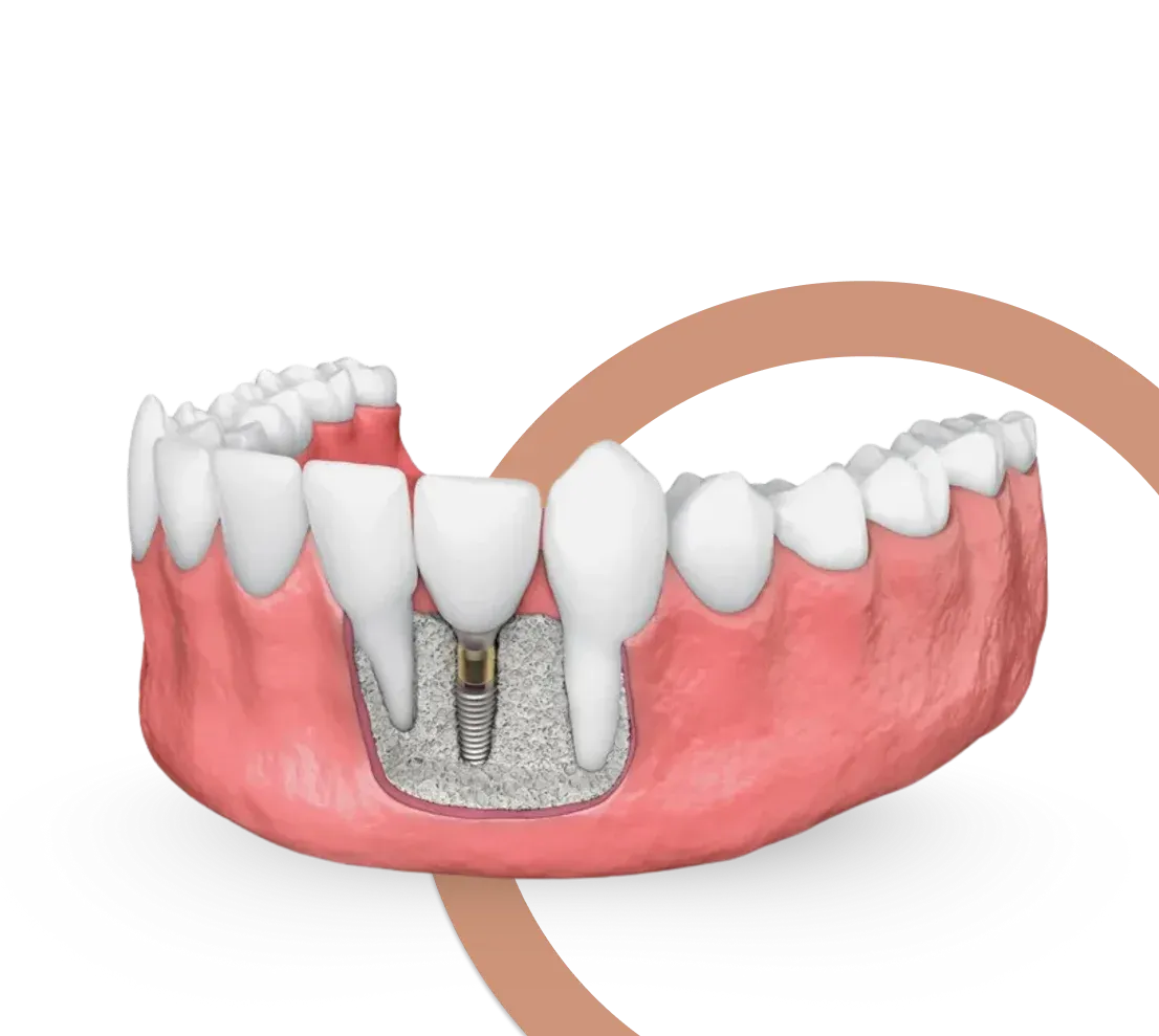 Dental bone graft supporting an implant in the jaw