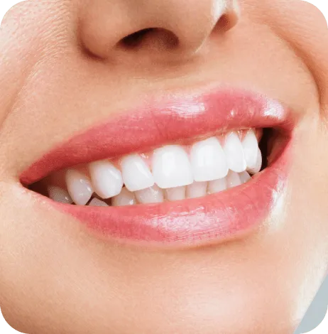 A bright, even smile after teeth whitening