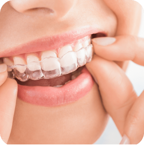 Clear Aligners Treatment in Noblesville