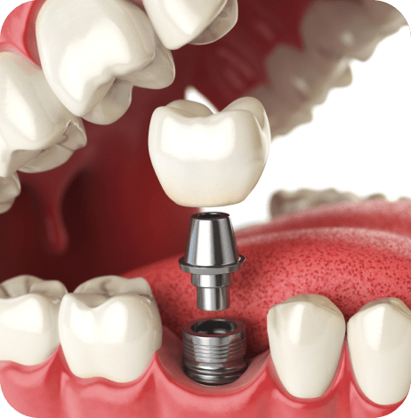 dental crown and bridges
