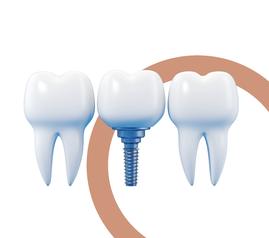 Dental implants in Noblesville