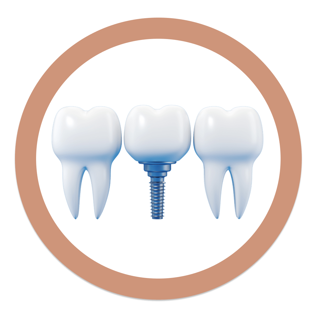 Dental implant between two natural teeth