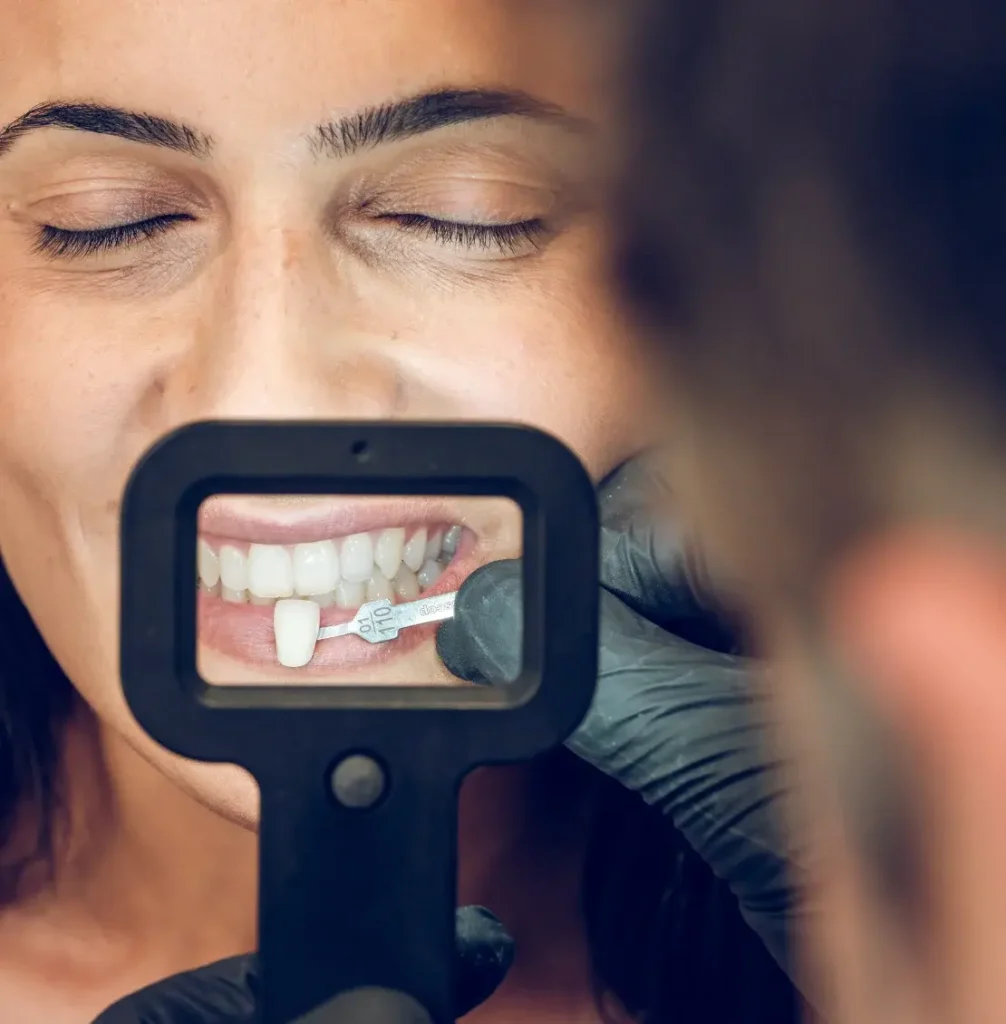 Dental veeners services