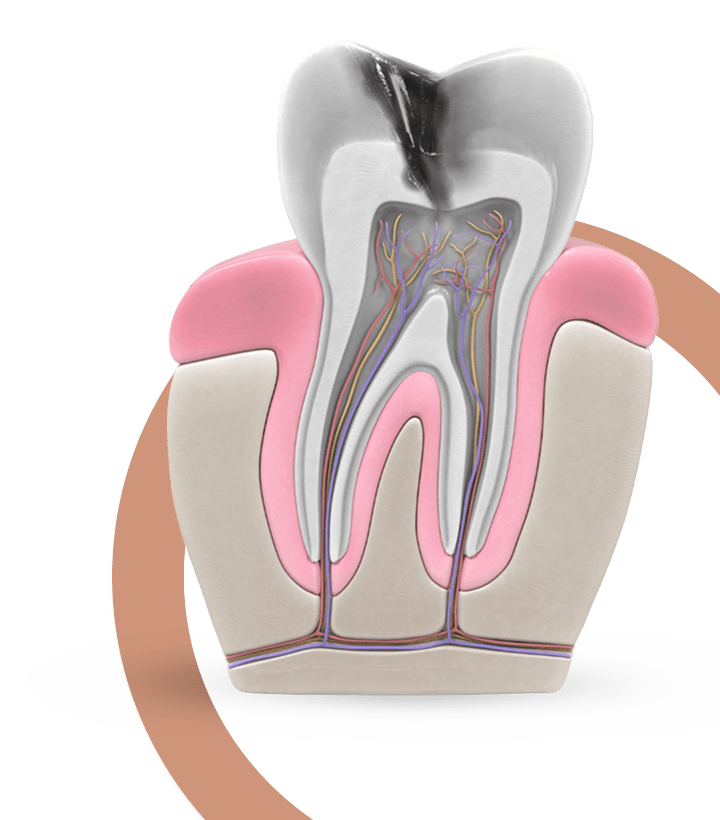 Root canal treatment