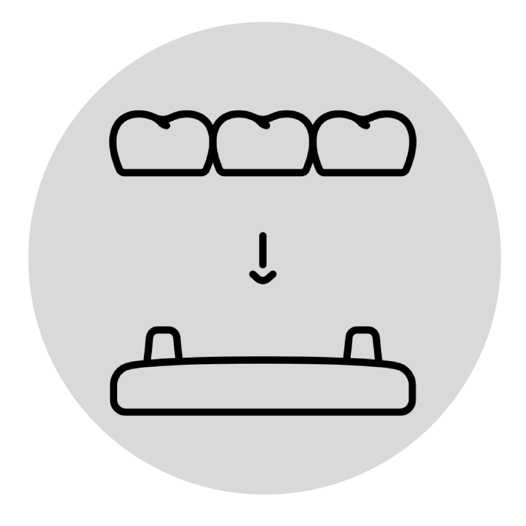 Cantilever Bridges​