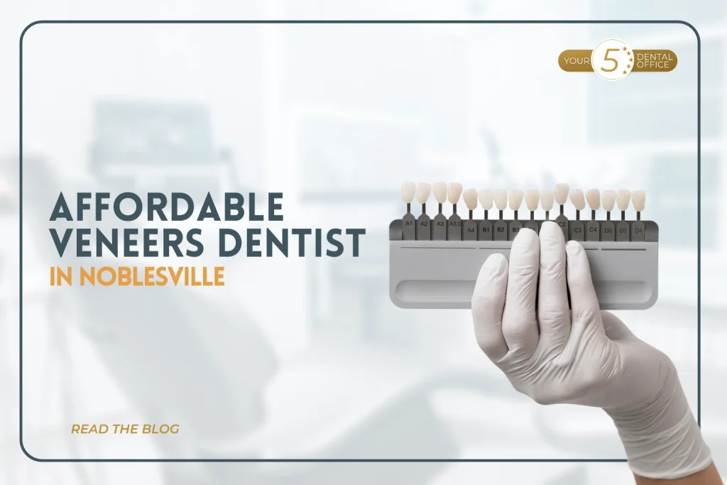 Veneers in Noblesville