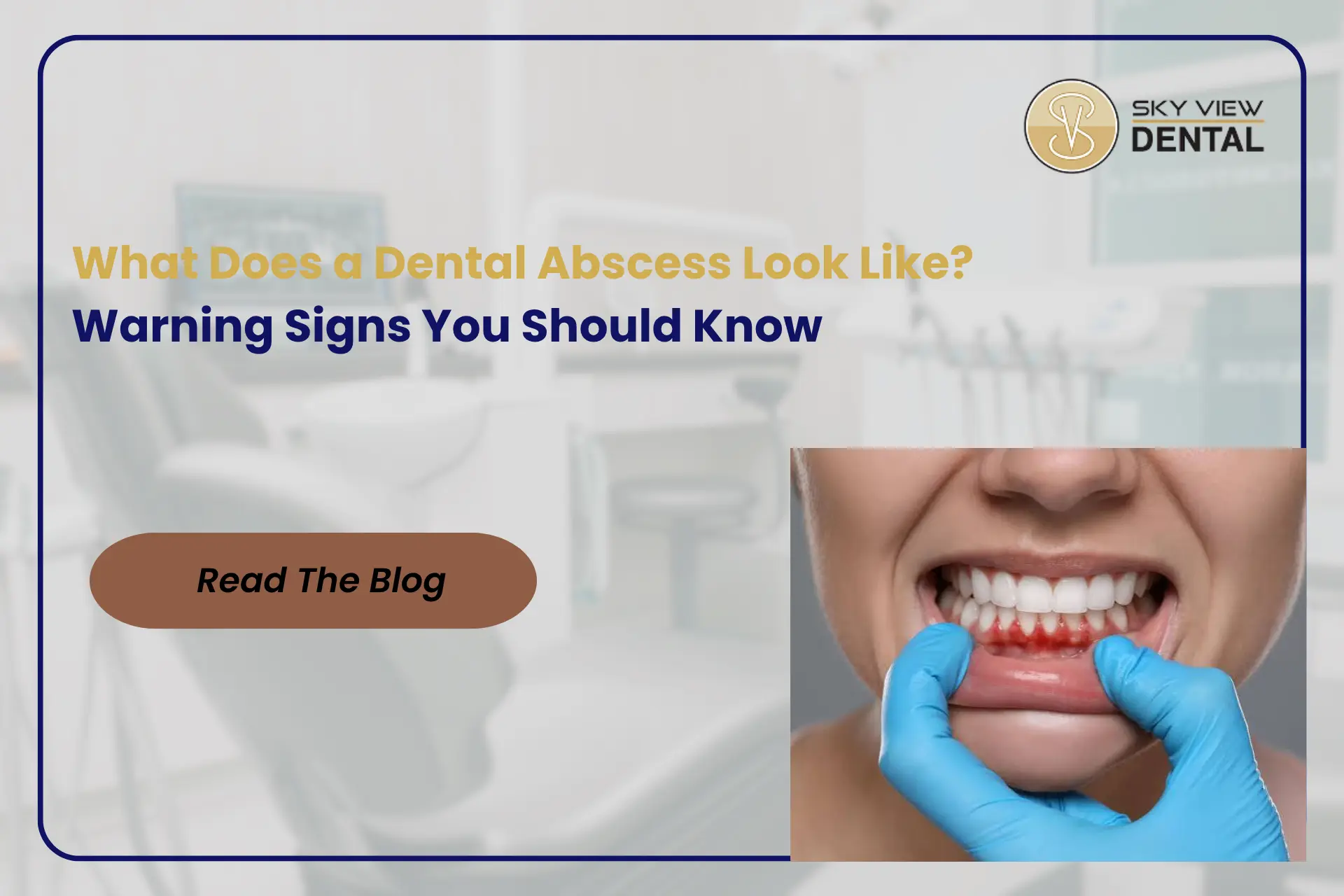 Dental abscess treatment
